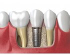 Tot ce ar trebui sa stiti despre implantul dentar - implant dentar pret