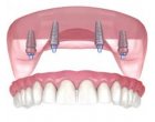 Ce inseamna la GermanDent un implant dentar ieftin?