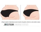 Liftingul de coapse, solutia pentru un corp cu forme ideale