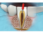 Ce este un tratament endodontic si cand este necesar