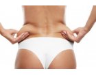 Interventia de lipoaspiratie