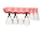 Indicatii si contraindicatii dupa inserarea unui implant dentar!