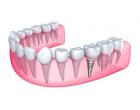 Implantul dentar, dincolo de mituri: de ce este cea mai sigura interventie stomatologica?
