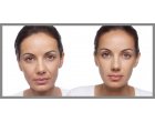 Sculpting facial: ce este si cand ai nevoie de o astfel de interventie?