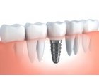 4 motive pentru care ar trebui sa iti faci un implant dentar