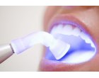 Tratamentele cu laser in medicina dentara si avantajele acestor tratamente