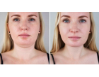 Liposuctia submentoniera – o metoda eficienta de corectare a conturului fetei