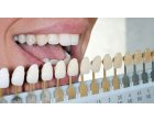Albirea dintilor - metoda profesională. De sărbători, fie ca zâmbetul să-ți strălucească