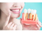 Trei beneficii ale implanturilor dentare