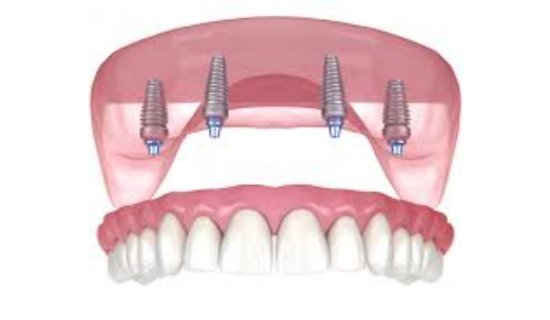 Ce inseamna la GermanDent un implant dentar ieftin?